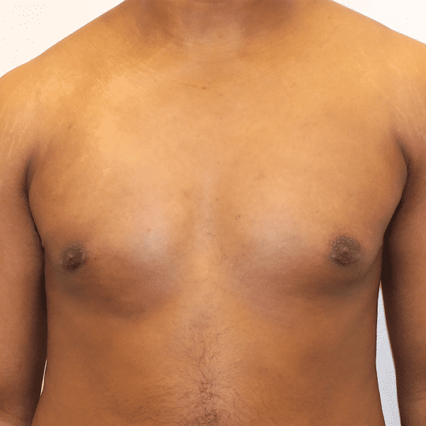 Case #3079 – Male Breast Reduction