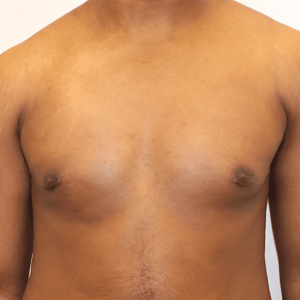 After Image: Case #3079 – Male Breast Reduction - front