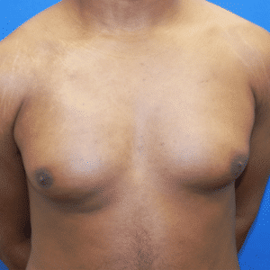 Case #3079 – Male Breast Reduction