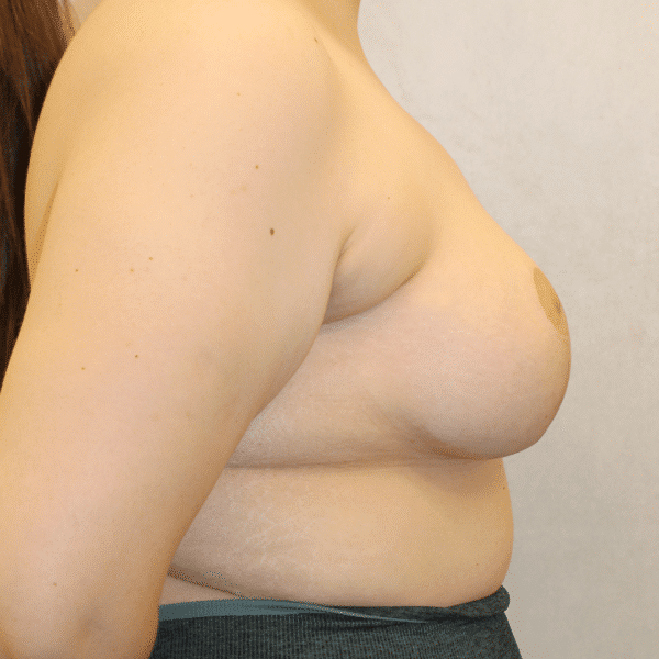 After Image: Case #3096 – Breast Lift with Implants - right-side