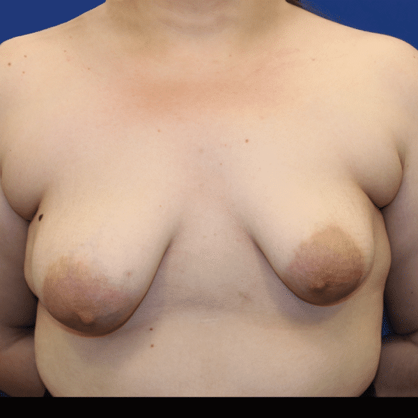 Before Image: Case #3096 – Breast Lift with Implants - front