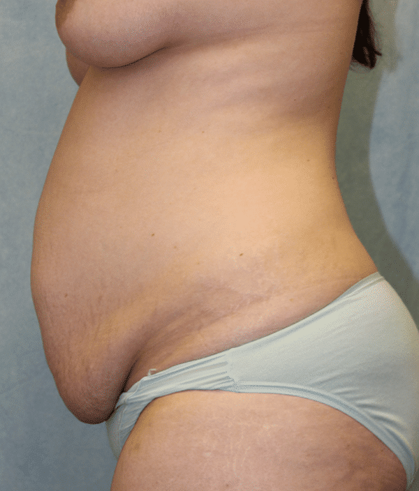 Before Image: Case #3207 – Mommy Makeover - left-side