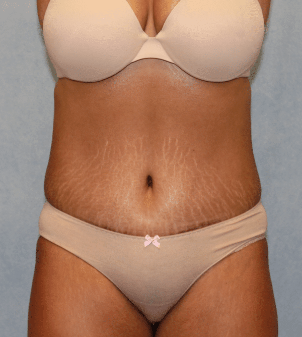 After Image: Case #3226 – Abdominoplasty – Tummy Tuck - front