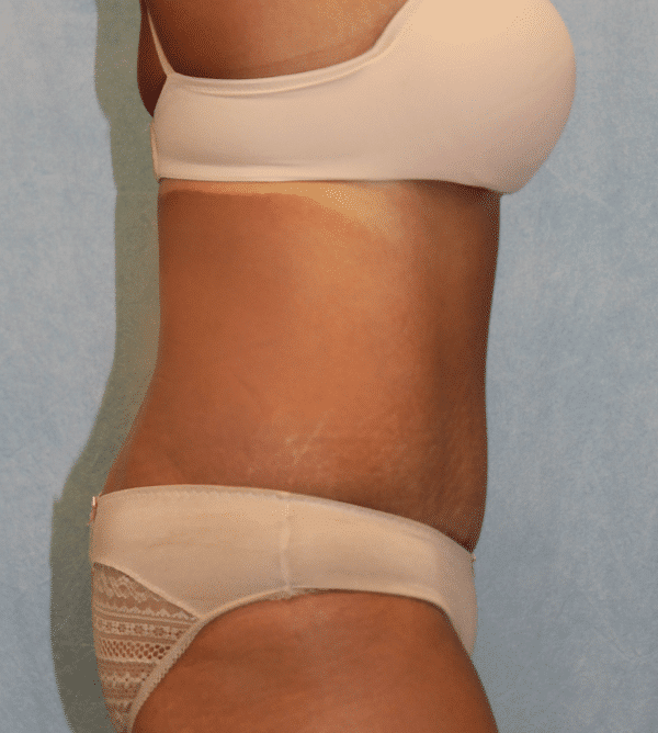 After Image: Case #3226 – Abdominoplasty – Tummy Tuck - right-side