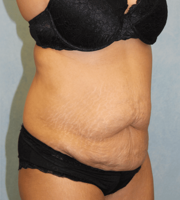 Before Image: Case #3226 – Abdominoplasty – Tummy Tuck - right-front-oblique