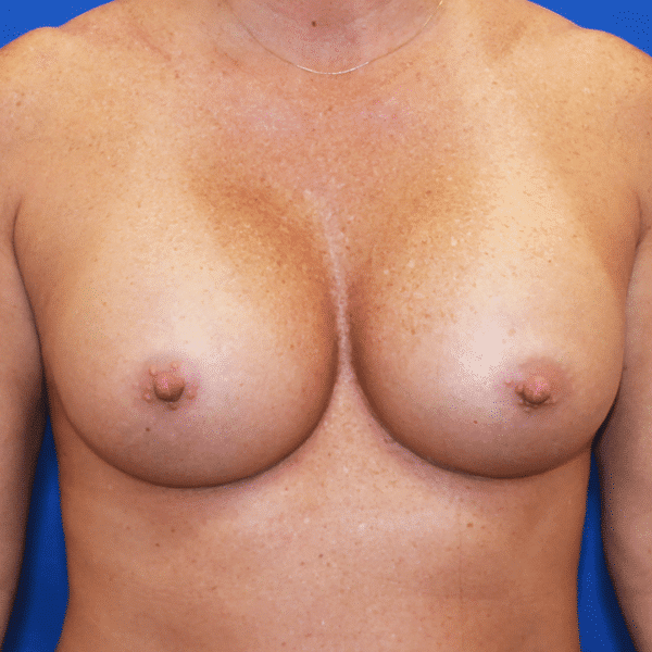 After Image: Case #3336 – Breast Augmentation - front