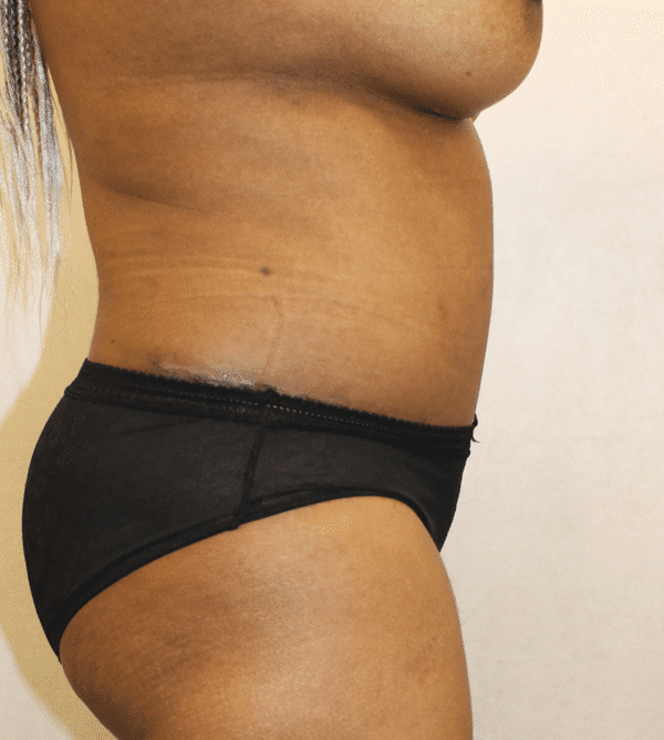 After Image: Case #3347 – Abdominoplasty – Tummy Tuck - right-side