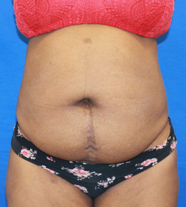 Case #3347 – Abdominoplasty – Tummy Tuck