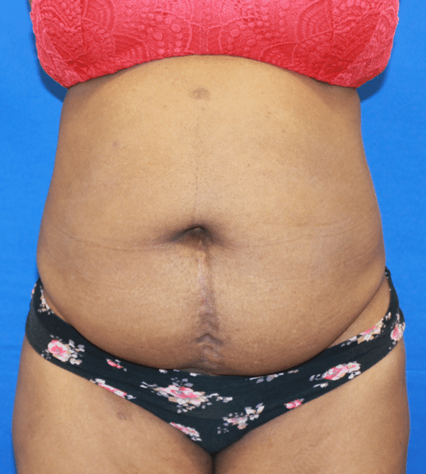 Before Image: Case #3347 – Abdominoplasty – Tummy Tuck - front