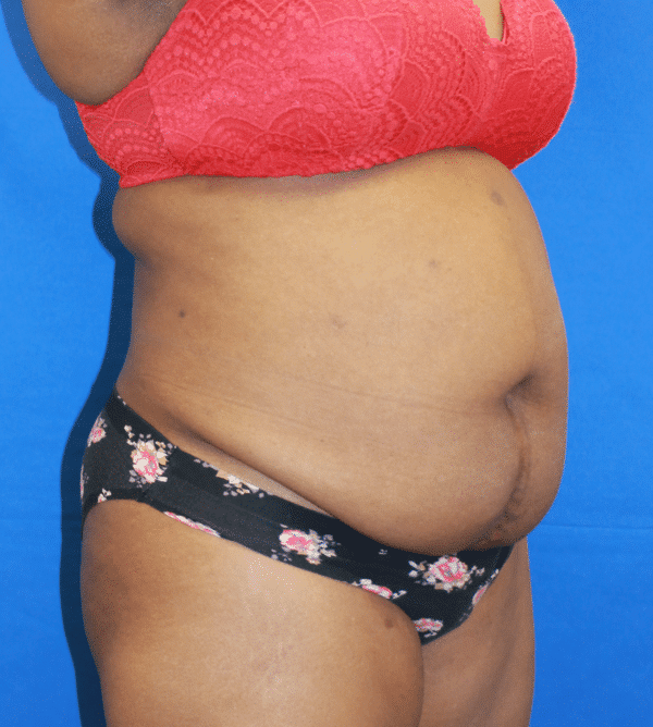 Before Image: Case #3347 – Abdominoplasty – Tummy Tuck - right-front-oblique