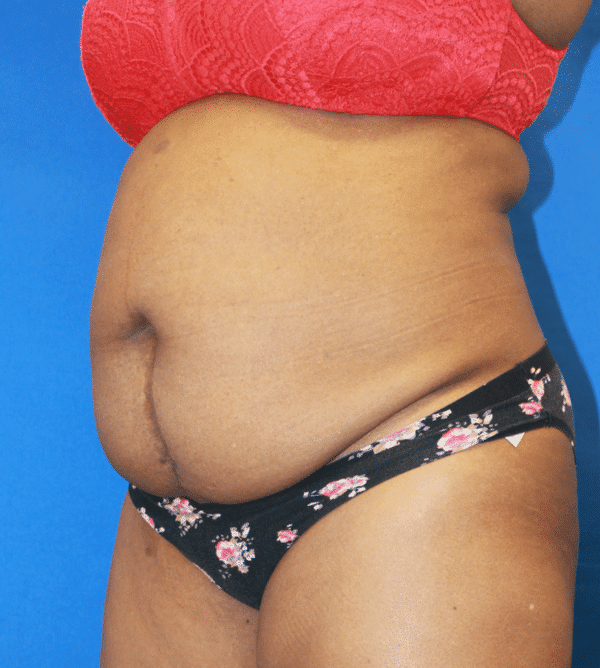 Before Image: Case #3347 – Abdominoplasty – Tummy Tuck - left-front-oblique