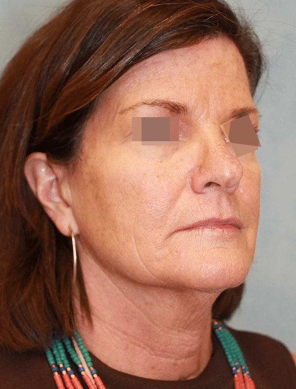 Before Image: Case #3362 – Facelift - right-front-oblique