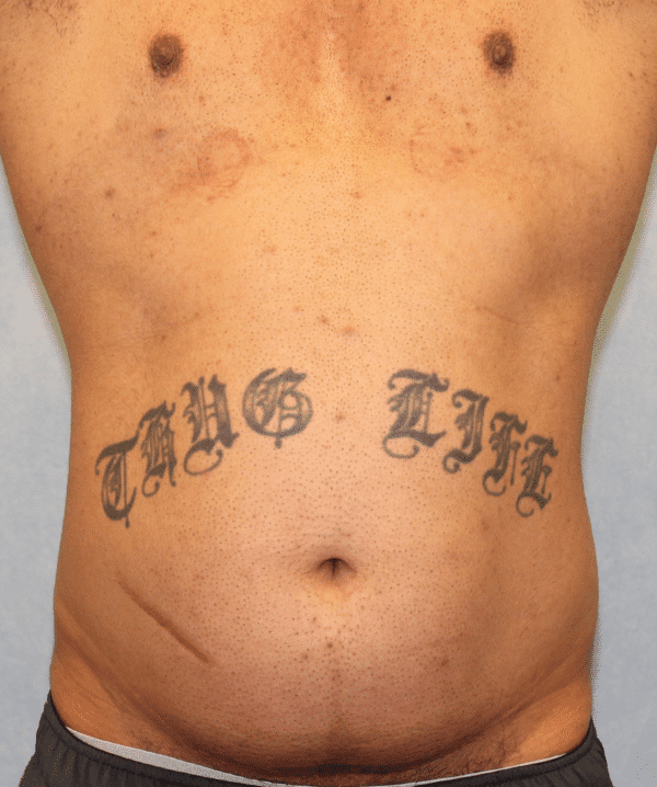 Case #3380 – Liposuction