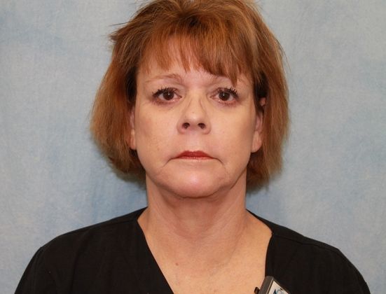 After Image: Case #339 – Facelift - front
