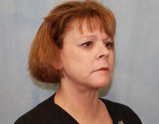 After Image: Case #339 – Facelift - right-front-oblique