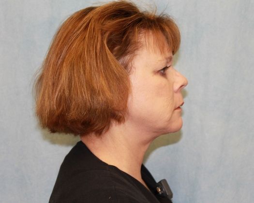 After Image: Case #339 – Facelift - right-side