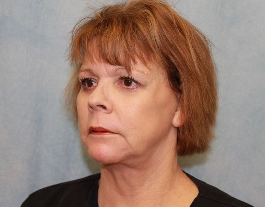 After Image: Case #339 – Facelift - left-front-oblique