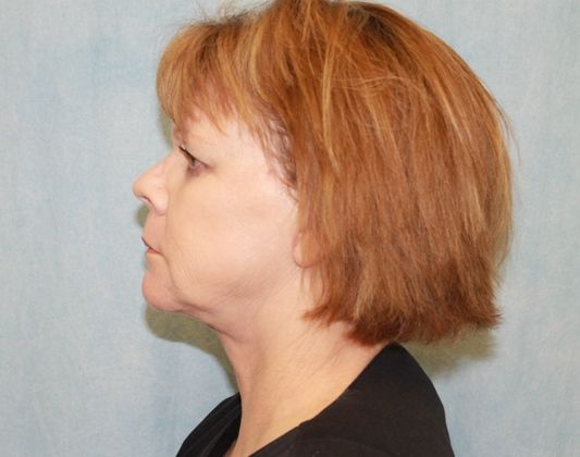 After Image: Case #339 – Facelift - left-side