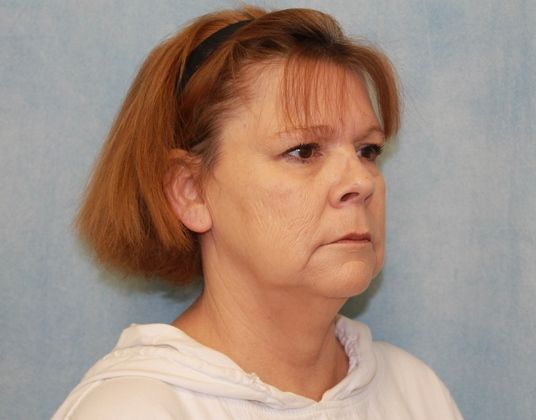 Before Image: Case #339 – Facelift - right-front-oblique