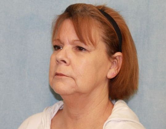 Before Image: Case #339 – Facelift - left-front-oblique