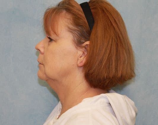 Before Image: Case #339 – Facelift - left-side