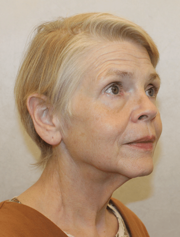 Before Image: Case #3415 – Facelift - right-front-oblique