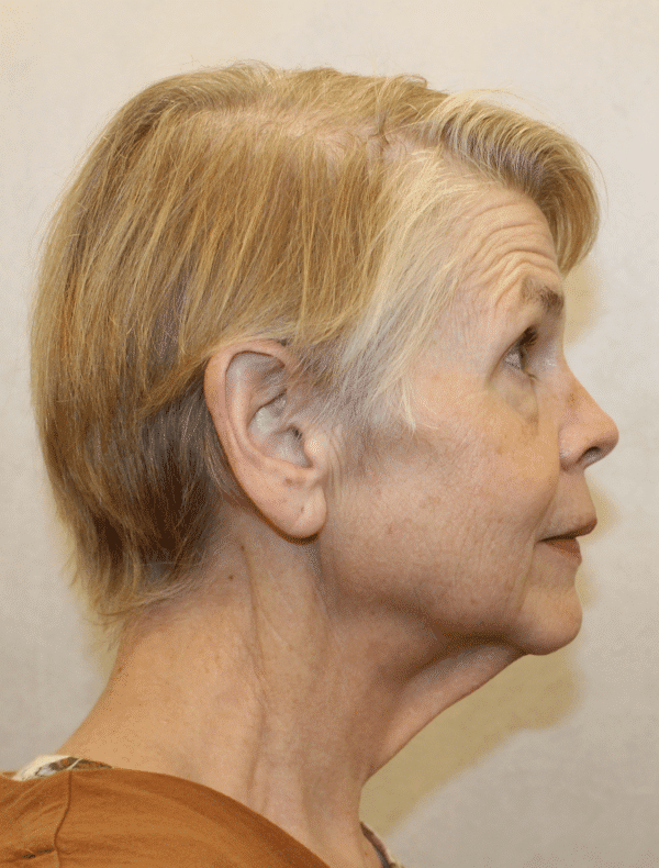 Before Image: Case #3415 – Facelift - right-side