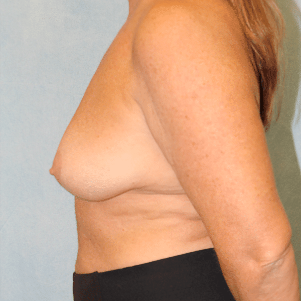 Before Image: Case #3426 – Breast Lift with Implants - left-side
