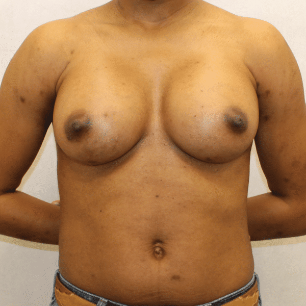 Case #3437 – Breast Augmentation