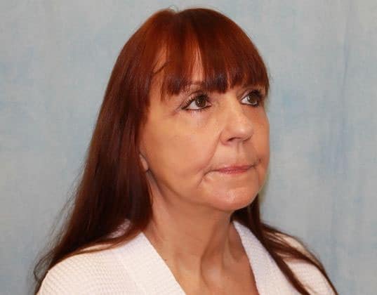 After Image: Case #351 – Facelift - right-front-oblique