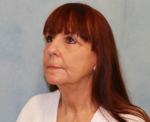 After Image: Case #351 – Facelift - left-front-oblique
