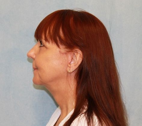 After Image: Case #351 – Facelift - left-side