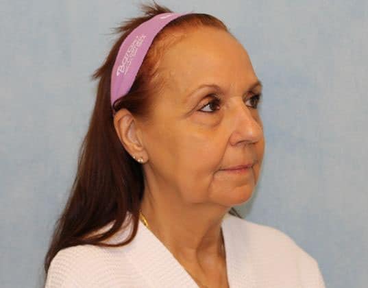 Before Image: Case #351 – Facelift - right-front-oblique