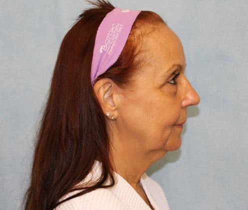 Before Image: Case #351 – Facelift - right-side