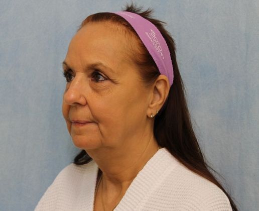 Before Image: Case #351 – Facelift - left-front-oblique