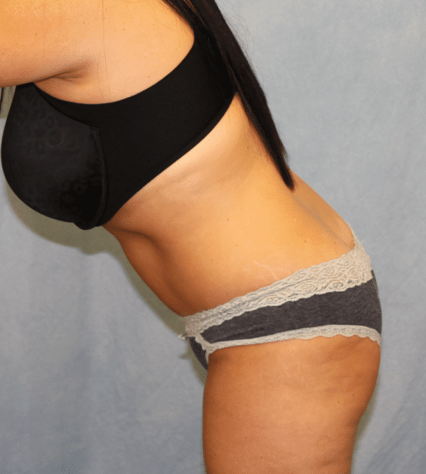 After Image: Case #3519 – Abdominoplasty – Tummy Tuck - left-side