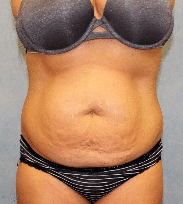 Before Image: Case #3519 – Abdominoplasty – Tummy Tuck - front