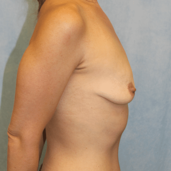 Before Image: Case #3530 – Breast Augmentation - right-side