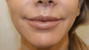 Case #3552 – Bullhorn Lip Lift