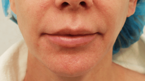 Before Image: Case #3552 – Bullhorn Lip Lift - front