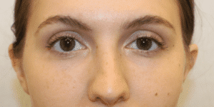 Case #3631 – Fat Grafting