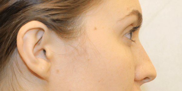 After Image: Case #3631 – Fat Grafting - right-side