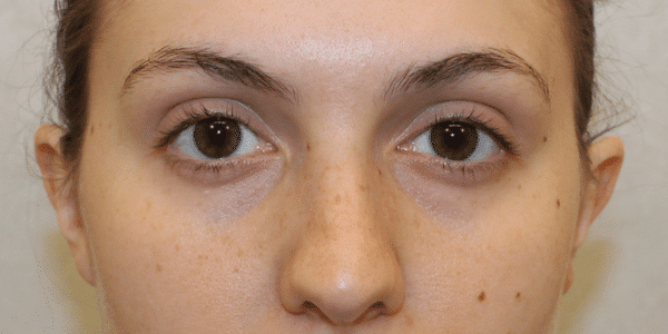 Before Image: Case #3631 – Fat Grafting - front