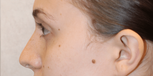Before Image: Case #3631 – Fat Grafting - left-side