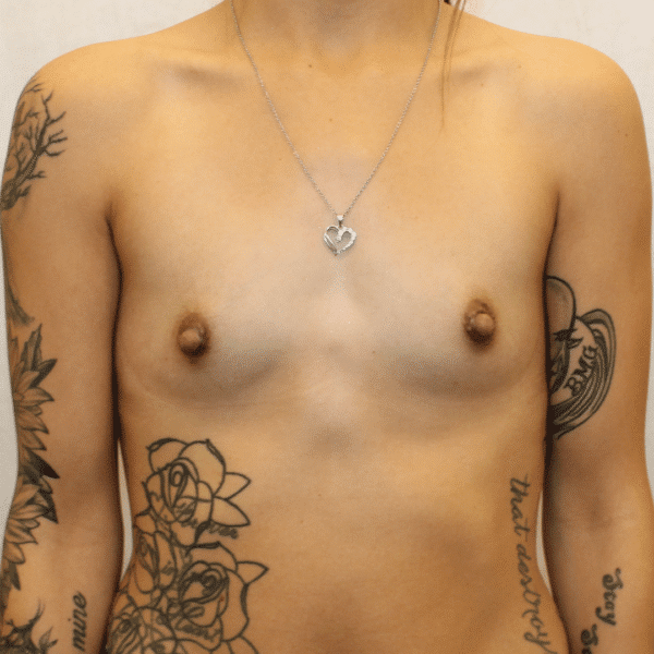 Before Image: Case #3657 – Breast Augmentation - front