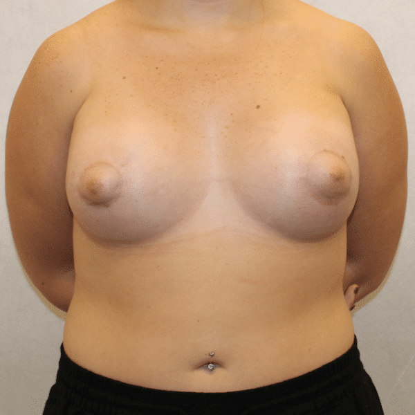 Case #3676 – Breast Lift with Implants
