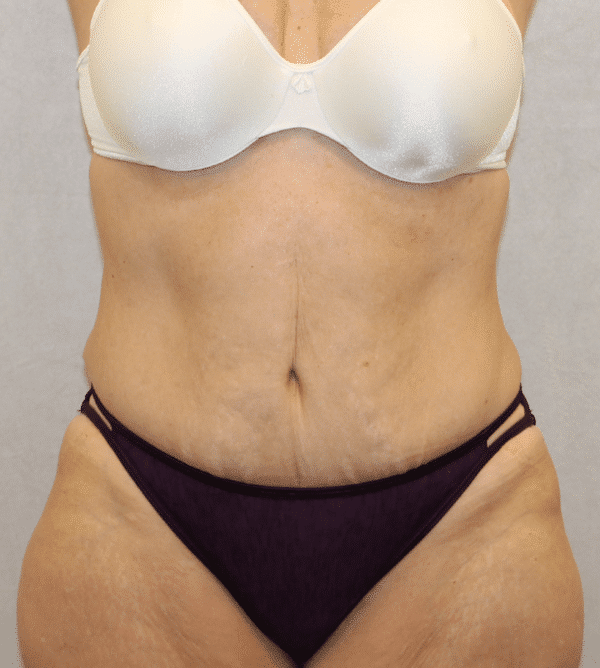 Case #3696 – Abdominoplasty – Tummy Tuck