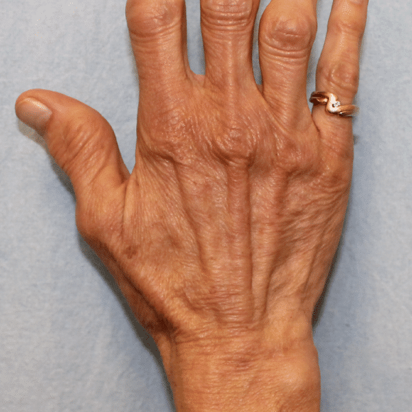 After Image: Case #3708 – Fat Grafting - front