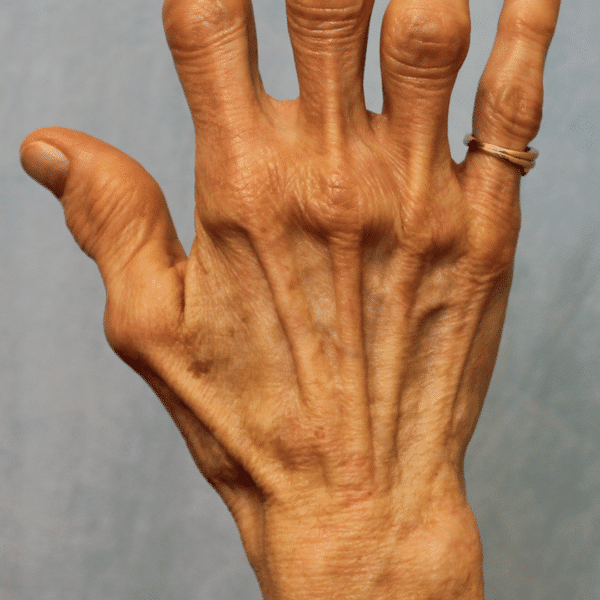 Before Image: Case #3708 – Fat Grafting - front