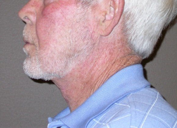 After Image: Case #371 – Neck Lift – Direct (For Men) - left-side